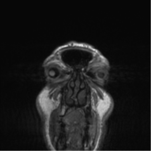 Normal brain MRI (non-focal epilepsy protocol) (Radiopaedia 53917-60040 Coronal T1 64).png