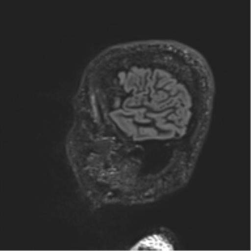 Normal brain MRI (non-focal epilepsy protocol) (Radiopaedia 53917-60040 Sagittal DIR 11).png