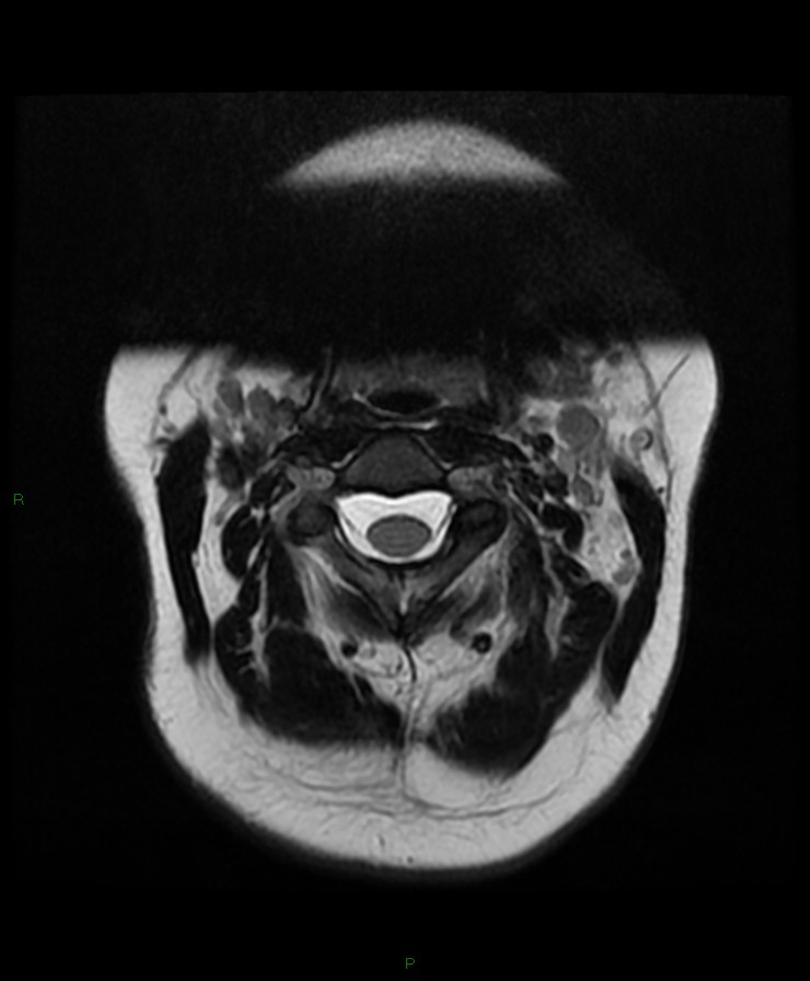 Normal cervical spine MRI (Radiopaedia 80146-93454 Axial T2 15).jpg