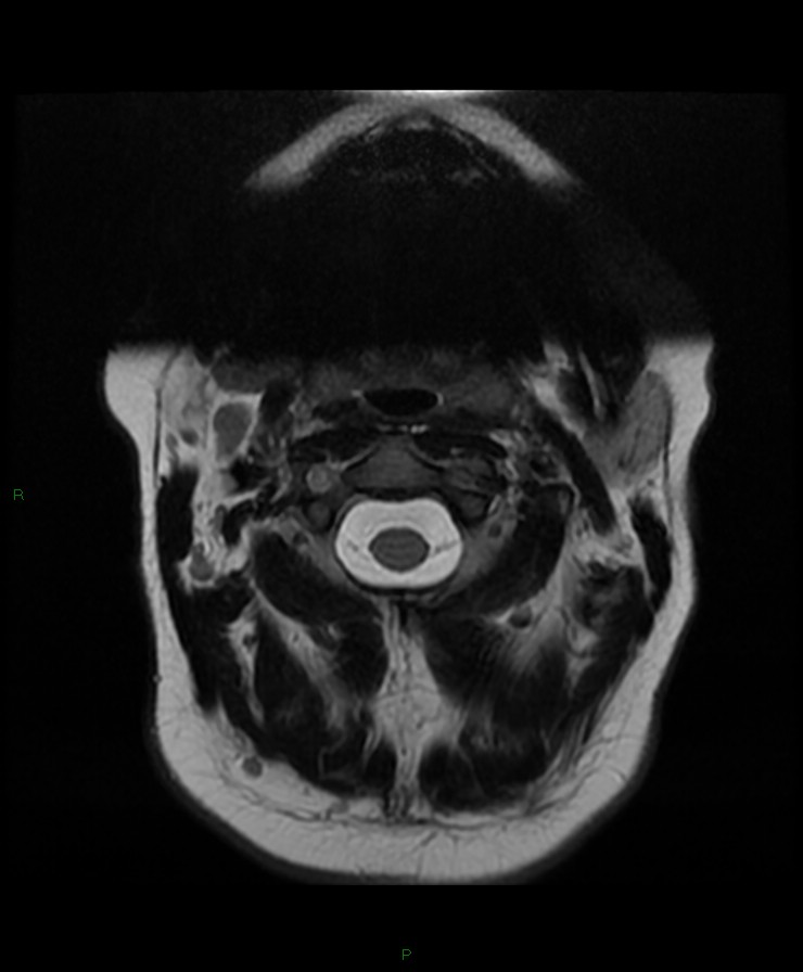 Normal cervical spine MRI (Radiopaedia 80146-93454 Axial T2 3).jpg