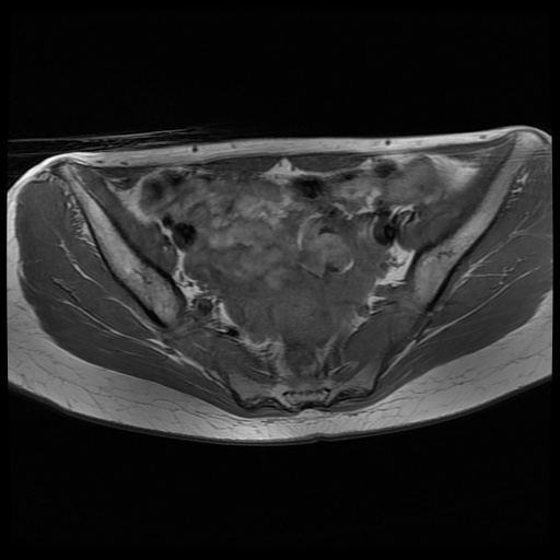File:Normal female pelvis MRI (retroverted uterus) (Radiopaedia 61832-69933 Axial T1 14).jpg