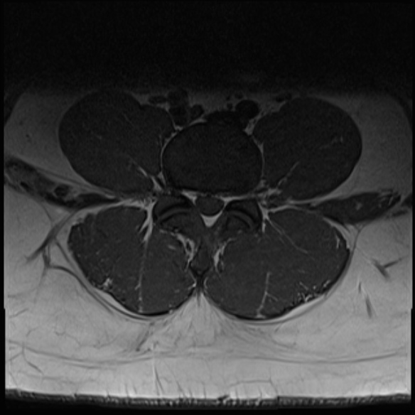 File:Normal lumbar spine MRI (Radiopaedia 47857-52609 Axial T1 19).jpg