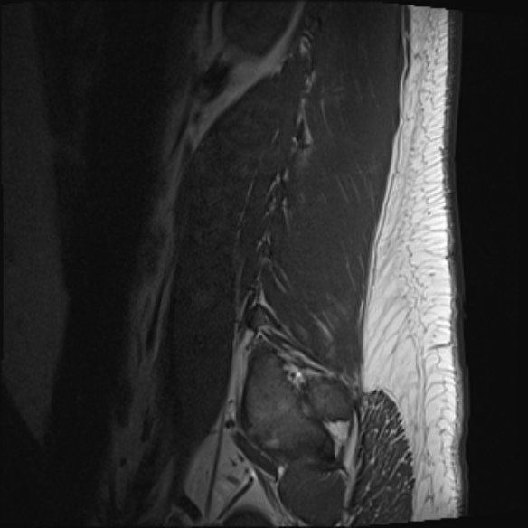 File:Normal lumbar spine MRI (Radiopaedia 47857-52609 Sagittal T1 21).jpg
