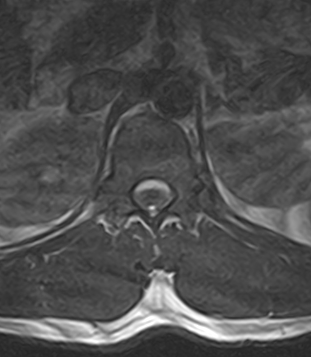 Normal lumbar spine MRI - low-field MRI scanner (Radiopaedia 40976-43699 Axial T2 11).jpg