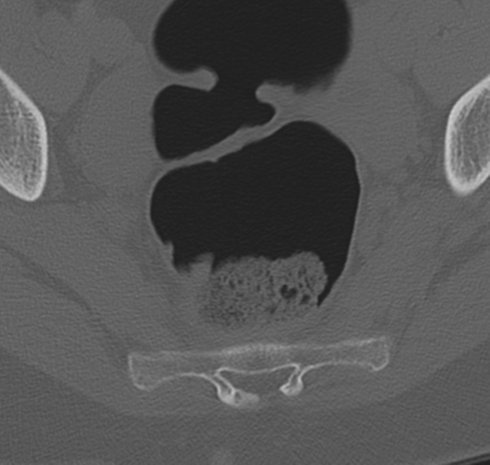 File:Normal lumbosacral CT (Radiopaedia 37923-39867 Axial bone window 101).png