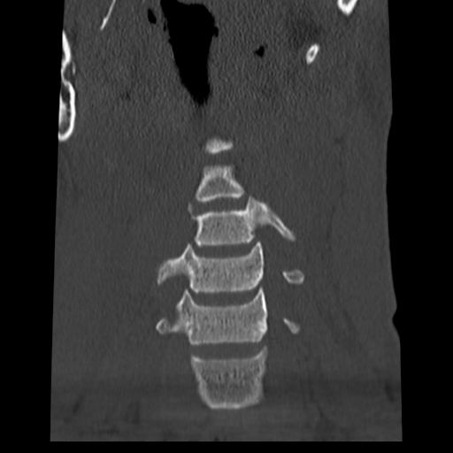 File:Normal trauma cervical spine (Radiopaedia 41017-43760 Coronal bone window 8).png