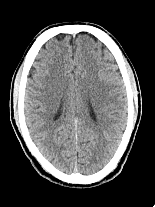 Normal trauma protocol brain and C-spine CT (Radiopaedia 83302-97709 Axial non-contrast 31).jpg