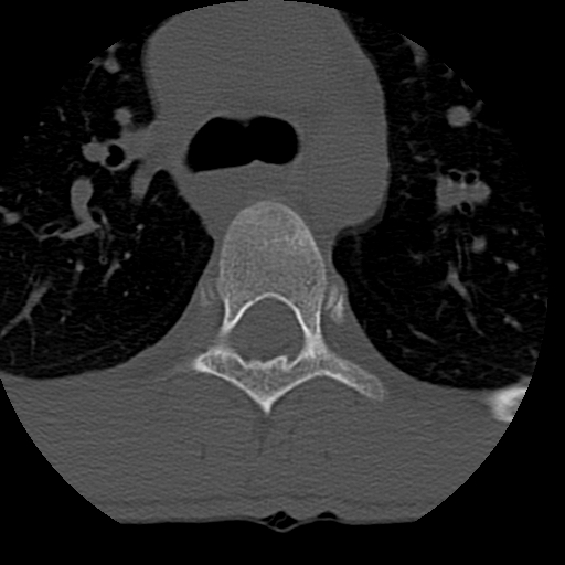 File:Normal trauma spine imaging (age 16) (Radiopaedia 45335-49358 Axial bone window 111).jpg