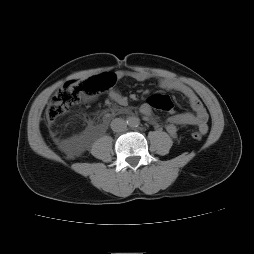 File:Obstructed kidney with perinephric urinoma (Radiopaedia 26889-27066 Axial non-contrast 35).jpg