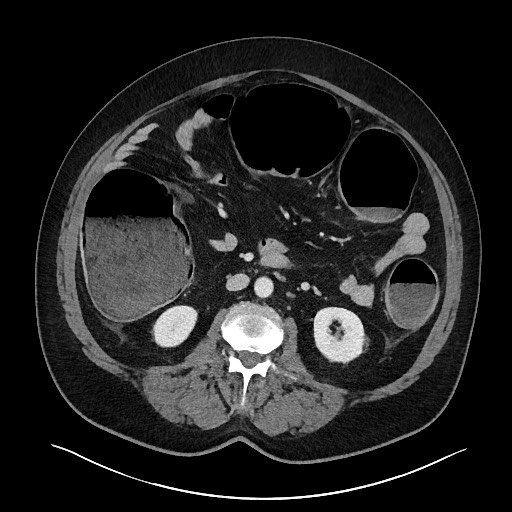 Obstructing sigmoid adenocarcinoma (Radiopaedia 58465-65619 A 79).jpg