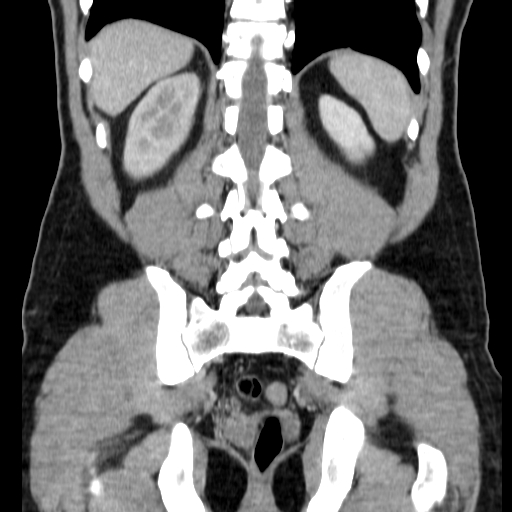 File:Obstructing ureteric calculus (Radiopaedia 18615-18514 C 60).jpg