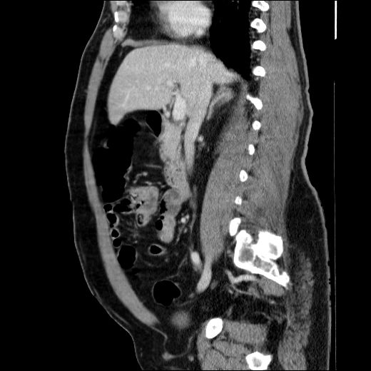 Obstructing ureteric calculus (Radiopaedia 49281-54373 C 56).jpg