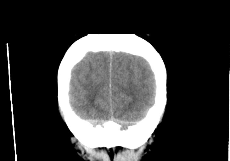 File:Obstructive hydrocephalus (Radiopaedia 30453-31119 Coronal non-contrast 35).jpg
