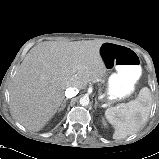 File:Obstructive superior vena cava tumor thrombus (Radiopaedia 28046-28306 A 54).jpg