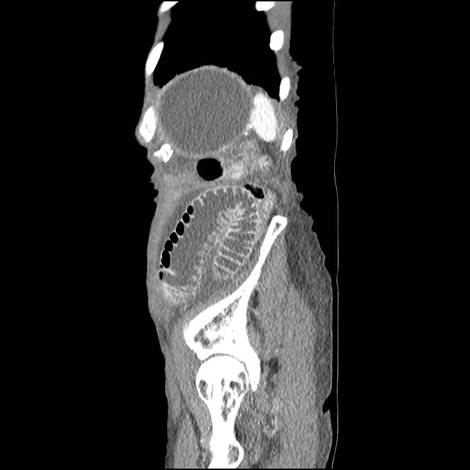 Obturator hernia causing small bowel obstruction (Radiopaedia 65522-74612 C 13).jpg