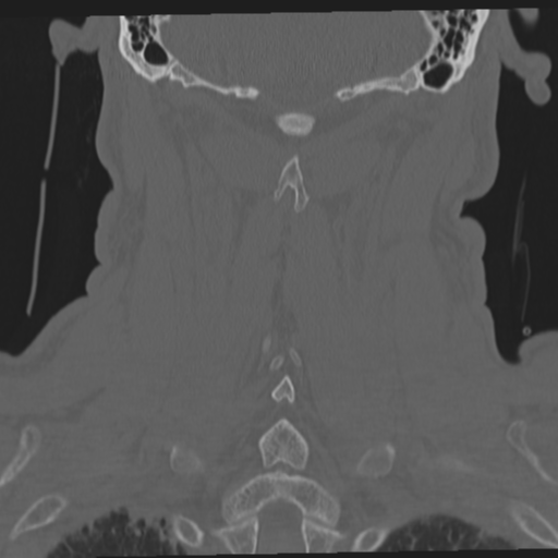 File:Occipital condyle fracture (Radiopaedia 33467-34517 Coronal bone window 51).png