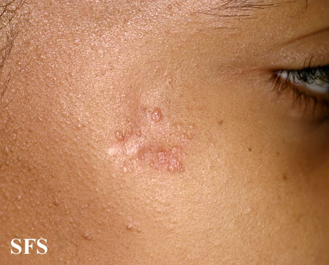 File:Sarcoidosis (Dermatology Atlas 10).jpg