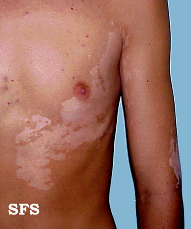 File:Vitiligo (Dermatology Atlas 11).jpg
