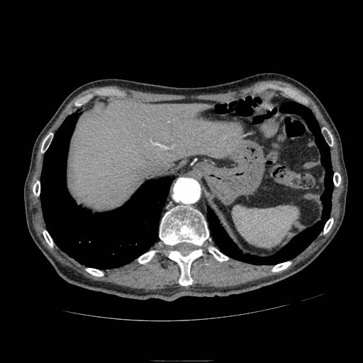 Abdominal aortic aneurysm (Radiopaedia 13341-13340 Axial C+ arterial phase 25).jpg