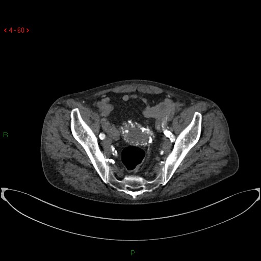 File:Abdominal aortic aneurysm (Radiopaedia 16155-15834 Axial C+ arterial phase 40).jpg