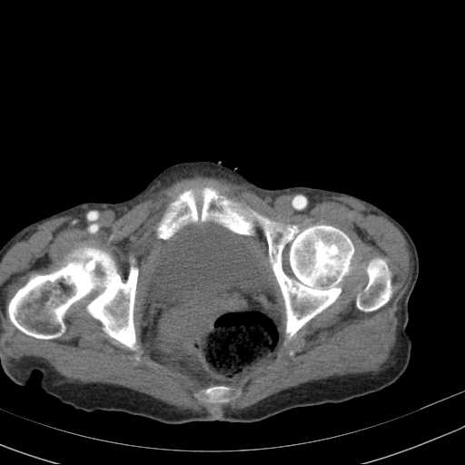File:Abdominal aortic aneurysm (Radiopaedia 20827-20742 Axial C+ arterial phase 39).jpg