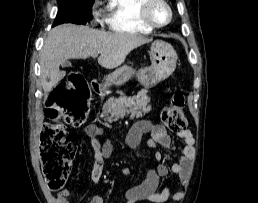 Abdominal aortic aneurysm (Radiopaedia 67117-76452 Coronal C+ arterial phase 14).jpg