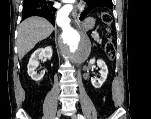 Abdominal aortic aneurysm (Radiopaedia 67117-76452 Coronal C+ arterial phase 61).jpg