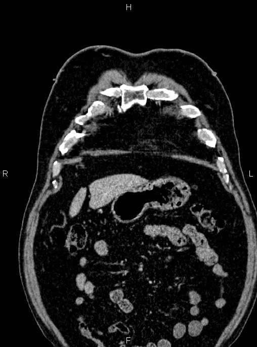 Abdominal aortic aneurysm (Radiopaedia 83094-97462 Coronal renal cortical phase 21).jpg