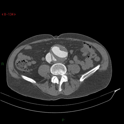 File:Abdominal aortic aneurysm rupture with aortocaval fistula (Radiopaedia 14897-14841 Axial C+ arterial phase 134).jpg