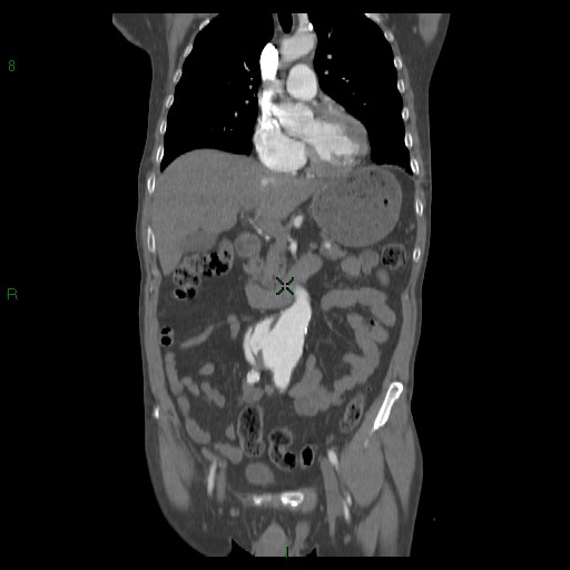 File:Abdominal aortic aneurysm rupture with aortocaval fistula (Radiopaedia 14897-14841 Coronal C+ arterial phase 22).jpg