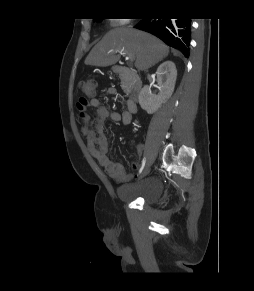Abdominal aortic aneurysm with thrombus fissuration (Radiopaedia 46218-50618 Sagittal C+ arterial phase 22).jpg