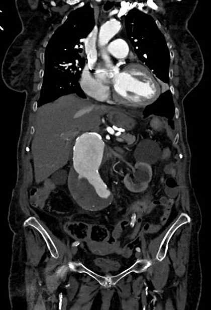 Abdominal aortic aneurysm with thrombus fissuration (Radiopaedia 73192-83919 Coronal C+ arterial phase 31).jpg