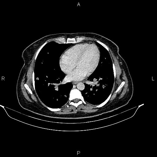 File:Abdominal lymphoma with sandwich sign (Radiopaedia 84378-99704 Axial C+ portal venous phase 3).jpg