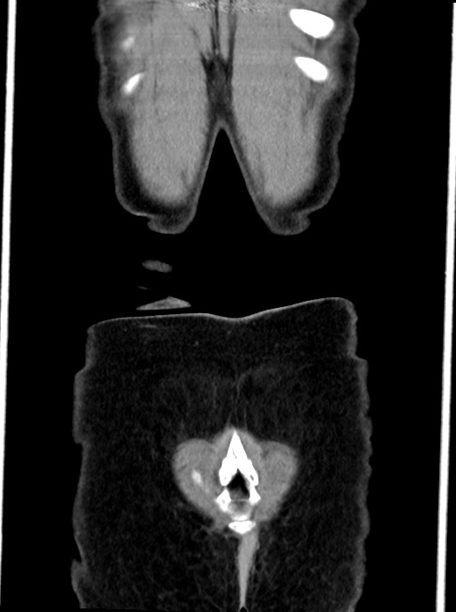 Abdominal wall and retroperitoneal tuberculosis (Radiopaedia 88137-104729 Coronal C+ portal venous phase 100).jpg