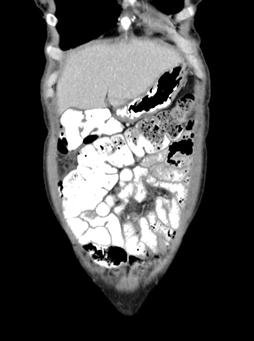 Abdominal wall and retroperitoneal tuberculosis (Radiopaedia 88137-104729 Coronal C+ portal venous phase 20).jpg