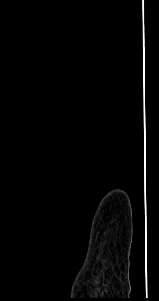 Abdominal wall and retroperitoneal tuberculosis (Radiopaedia 88137-104729 Sagittal C+ portal venous phase 153).jpg