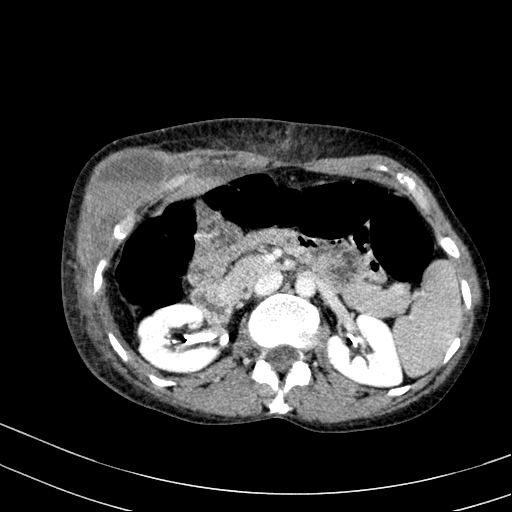 File:Abdominal wall hematoma with active bleeding (Radiopaedia 83915-99117 Axial C+ portal venous phase 20).jpg