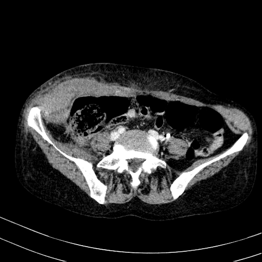Abdominal wall hematoma with active bleeding (Radiopaedia 83915-99117 Axial C+ portal venous phase 84).jpg