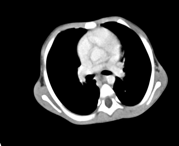Abdominopelvic rhabdomyosarcoma (Radiopaedia 78356-90984 Axial C+ portal venous phase 19).jpg