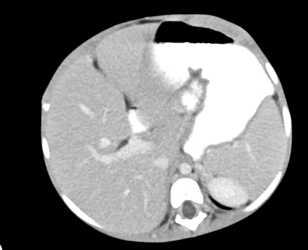 Abdominopelvic rhabdomyosarcoma (Radiopaedia 78356-90984 Axial C+ portal venous phase 54).jpg