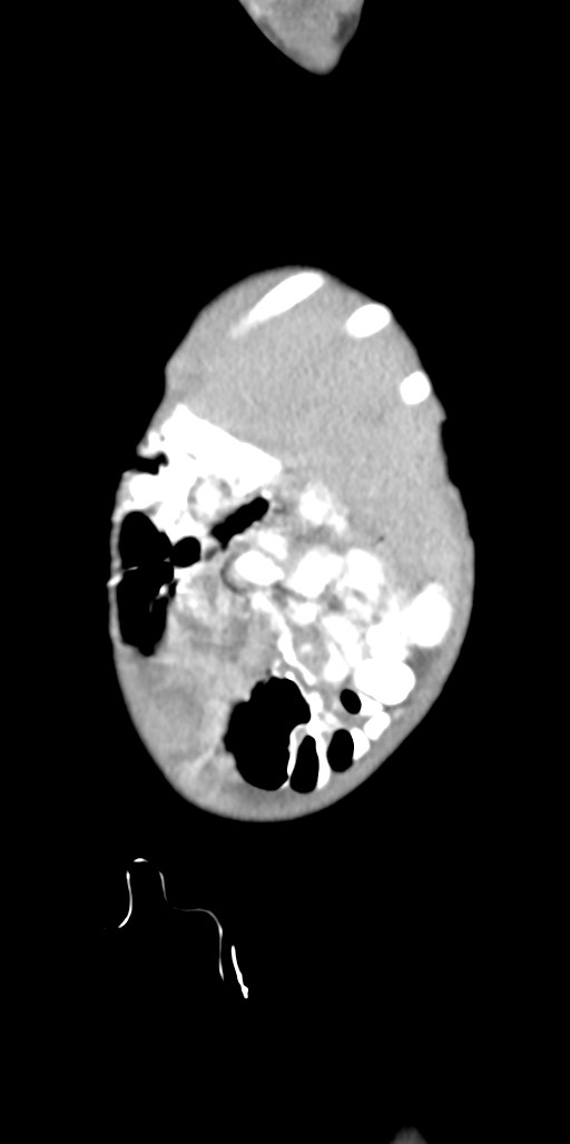 Abdominopelvic rhabdomyosarcoma (Radiopaedia 78356-90984 Sagittal C+ portal venous phase 91).jpg