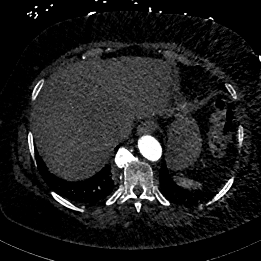 File:Aberrant right subclavian artery with Kommerell diverticulum (Radiopaedia 47982-52769 Axial C+ arterial phase 83).png
