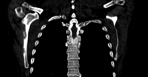 Accesory rib joint (Radiopaedia 71987-82452 Coronal bone window 47).jpg
