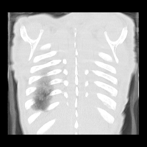 Accessory left horizontal fissure with lingular pneumonia (Radiopaedia 53763-59843 Coronal lung window 41).jpg
