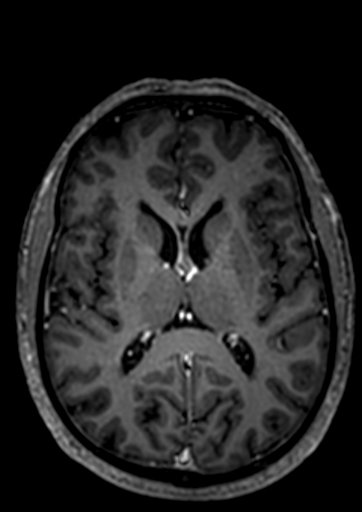 Accessory middle cerebral artery (Radiopaedia 73114-83828 Axial T1 C+ 16).jpg