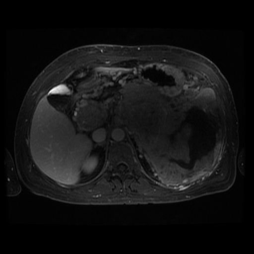 Acinar cell carcinoma of the pancreas (Radiopaedia 75442-86668 D 75).jpg