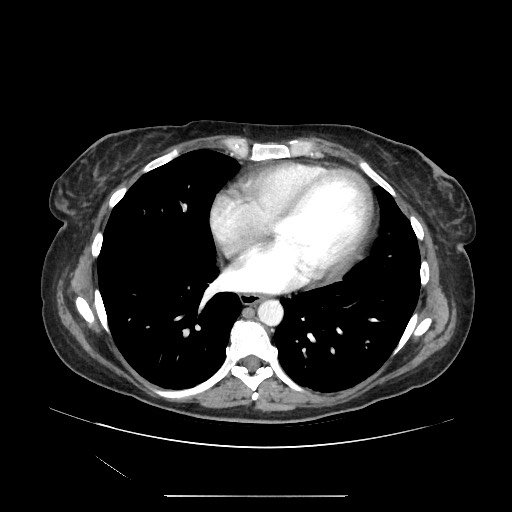 Acinar cell carcinoma of the pancreas (Radiopaedia 75442-86669 Axial C+ portal venous phase 2).jpg