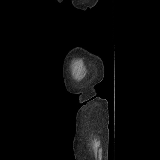 Acinar cell carcinoma of the pancreas (Radiopaedia 75442-86669 Sagittal C+ portal venous phase 18).jpg