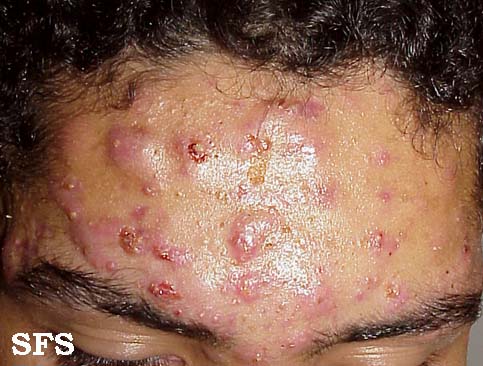 File:Acne (Dermatology Atlas 4).jpg