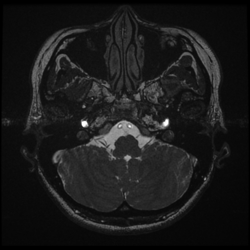 File:Acoustic neuroma (Radiopaedia 34049-35283 Axial 31).png